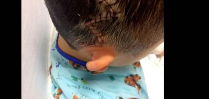 8歲華童體育課上頭部重傷 區長吁徹查
