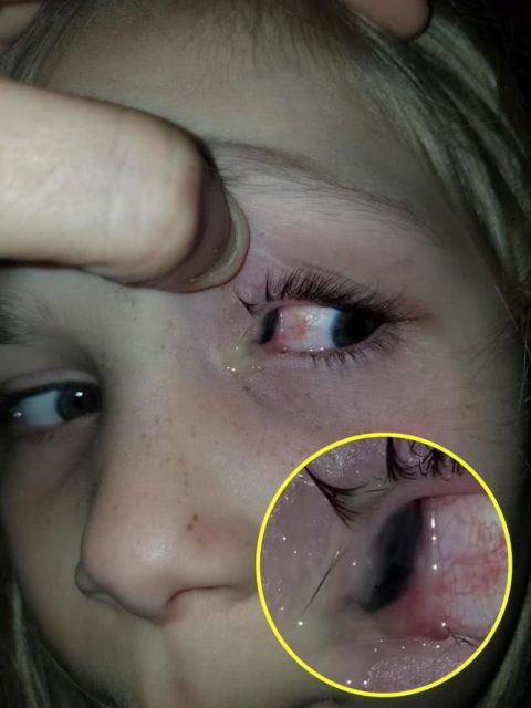 美國女孩頭部遭甲蟲侵入，9小時後從眼睛擠出，還淡定為蟲子起名