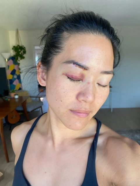 華裔真人秀女選手在洛杉磯街頭遭隨機襲擊！臉上縫數針