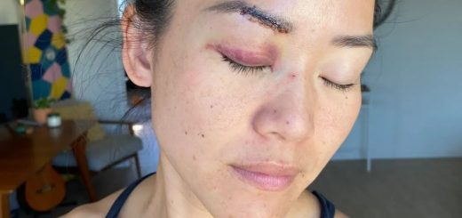 华裔真人秀女选手在洛杉矶街头遭随机袭击！脸上缝数针