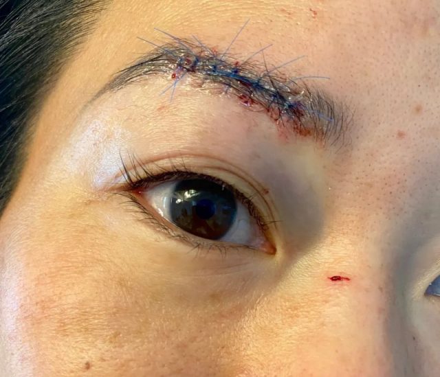 華裔真人秀女選手在洛杉磯街頭遭隨機襲擊！臉上縫數針