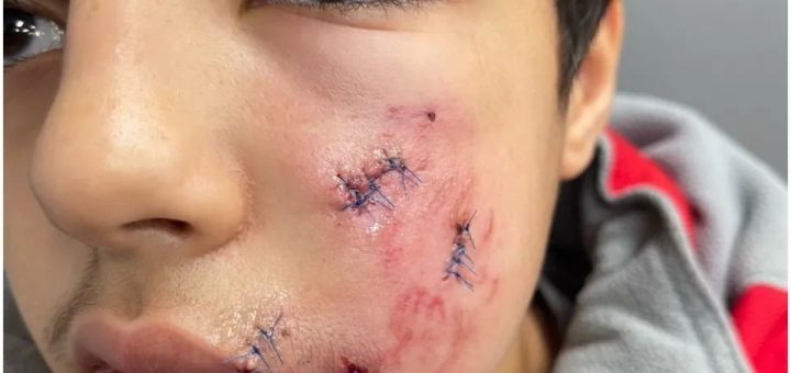 华人爱犬抓走获释4天后闯祸，13岁少年被咬成终身残疾
