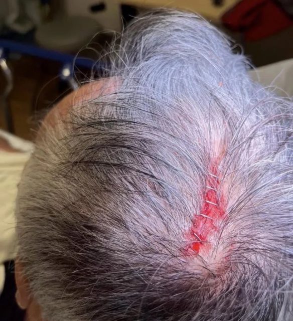 华裔市议员在旧金山街头遇袭，头被砸破失去知觉