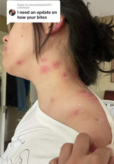 “好痒！”女子在旅馆被咬一身包 从脖子到手臂无一幸免 都是床惹的祸！