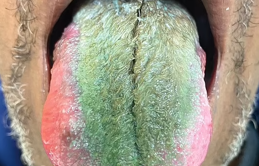 舌头变绿又长毛！美64岁男子抽烟+抗生素 惊现罕见副作用