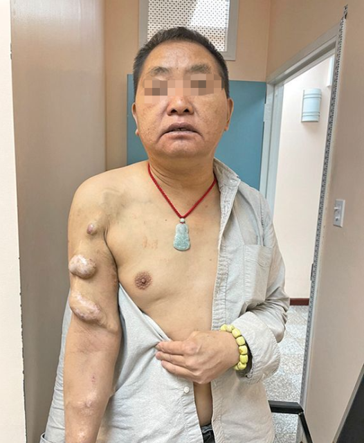 悲劇！華男偷渡來美，雙腎被摘透析20多年，陷入絕境求糊口。