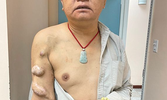 悲劇！華男偷渡來美，雙腎被摘透析20多年，陷入絕境求糊口。