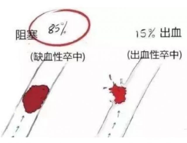 2019年“世界脑卒中日”来了，超全漫画图解，别错过！