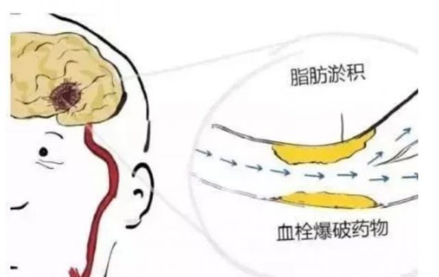 2019年「世界腦卒中日」來了，超全漫畫圖解，別錯過！