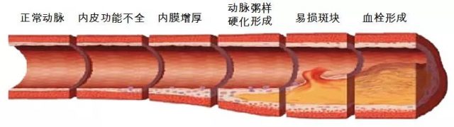 血栓大多是吃出来的，医生：这四种食物一定要少吃！