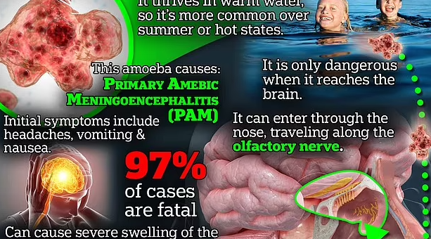 恐怖! 美国男子鼻子进水 染食脑变形虫惨死! 5天暴毙 洗澡洗脸都危险