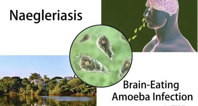 美国男子自来水洗鼻子感染食脑虫死亡